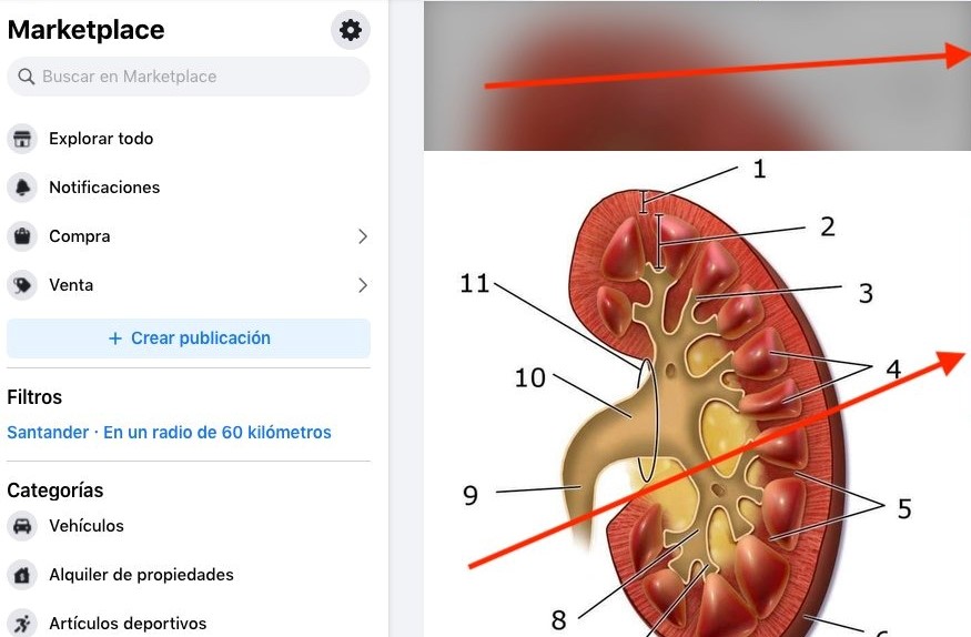 Un riñón en Marketplace: comercio de órganos es peligroso y se paga con cárcel, alerta la Ontv
