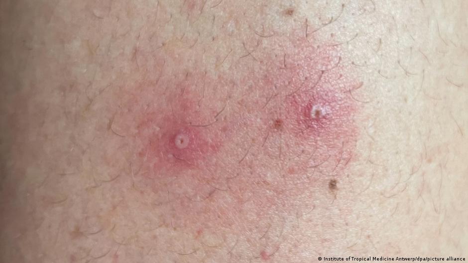 Casos de viruela del mono aumentan un 77 por ciento en una semana