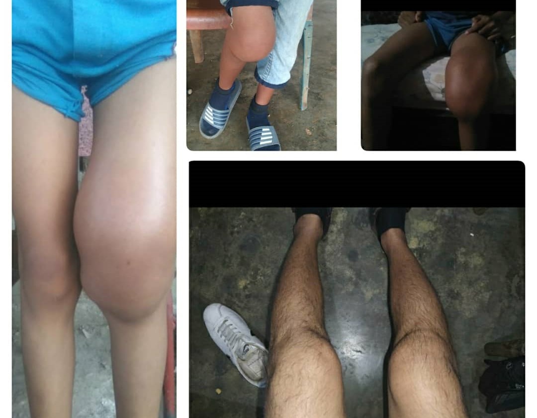 "Hay pacientes en riesgo": personas con hemofilia denuncian falta de tratamiento en Venezuela